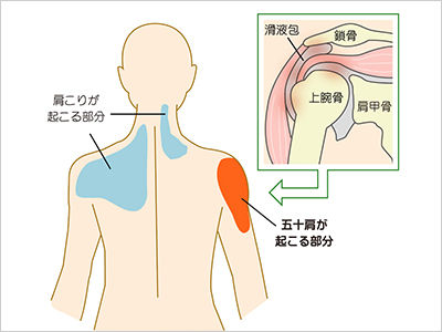 肩関節周囲炎